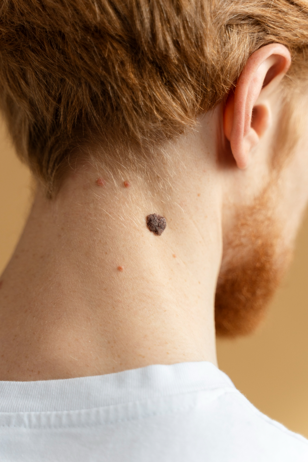 close-up-young-man-with-mole-neck